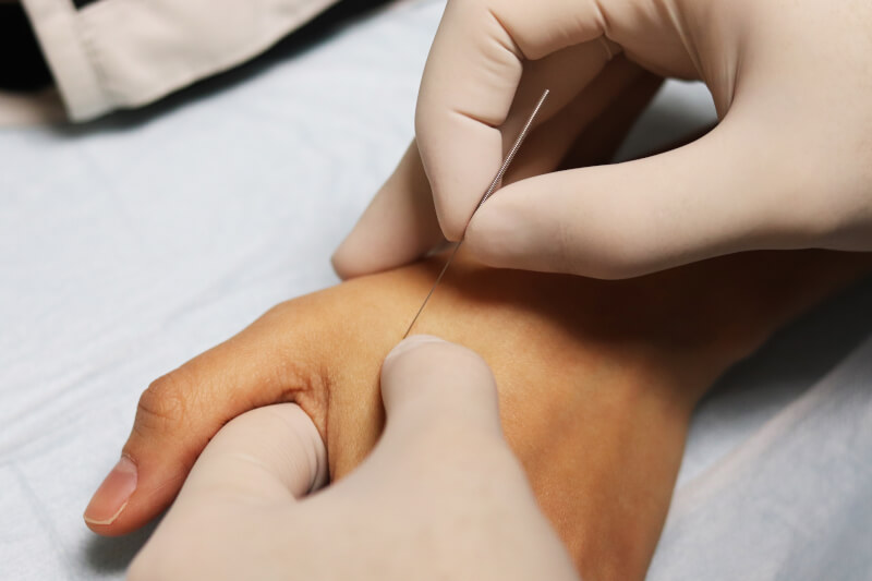 Dry needling therapie schmerzen lindern und entspannen 