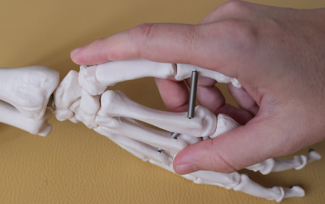 Rhizarthrose - Interessante biomechanische Aspekte